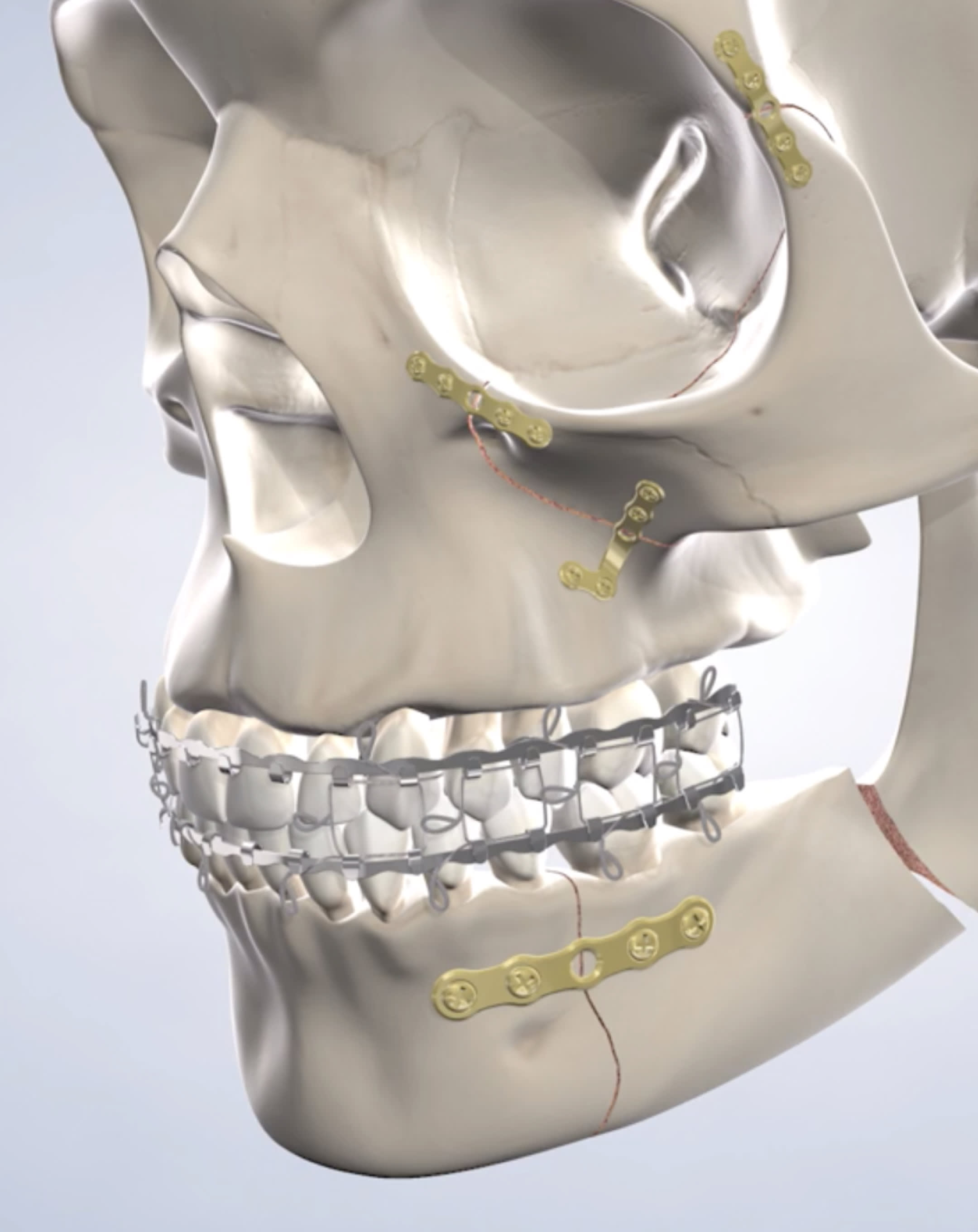 Metal holding face and teeth in place.