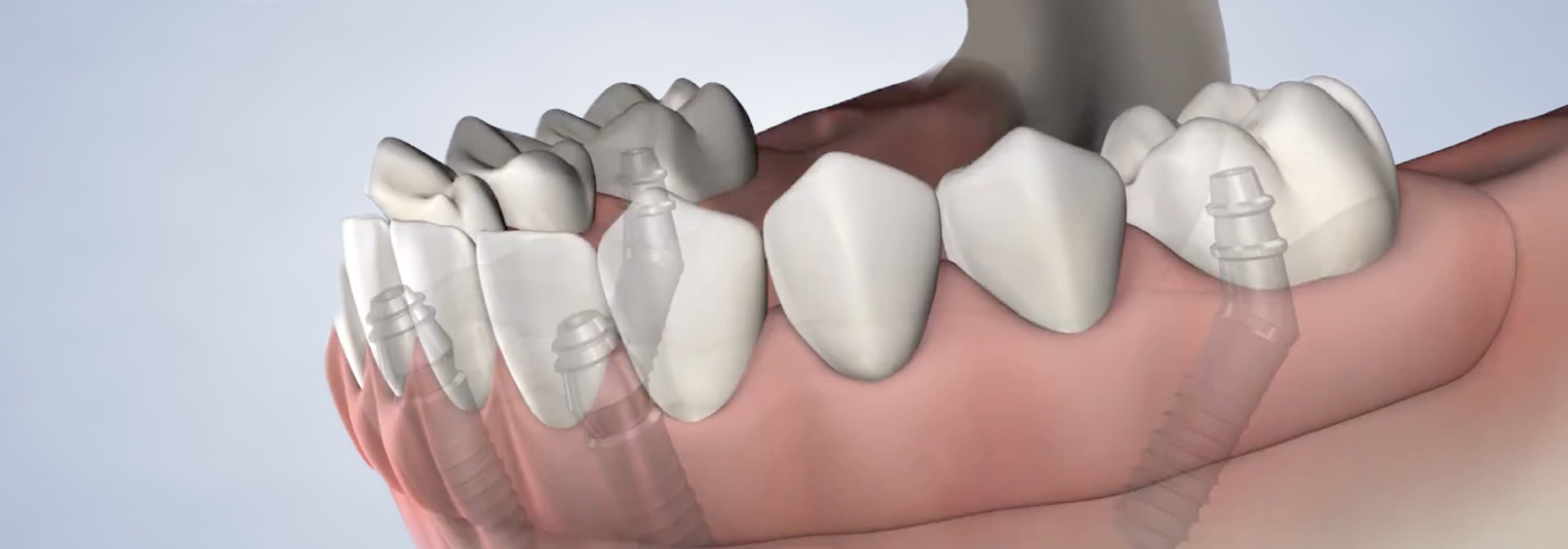 Bottom row of teeth with screws holding in place.