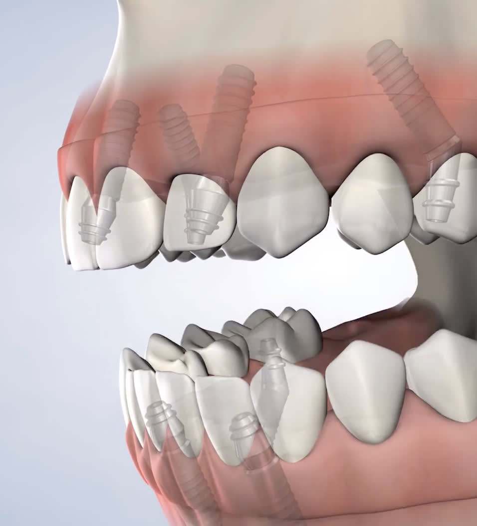 Full-Arch procedure showing 
 columns of screws throughout gum line for individual teeth.