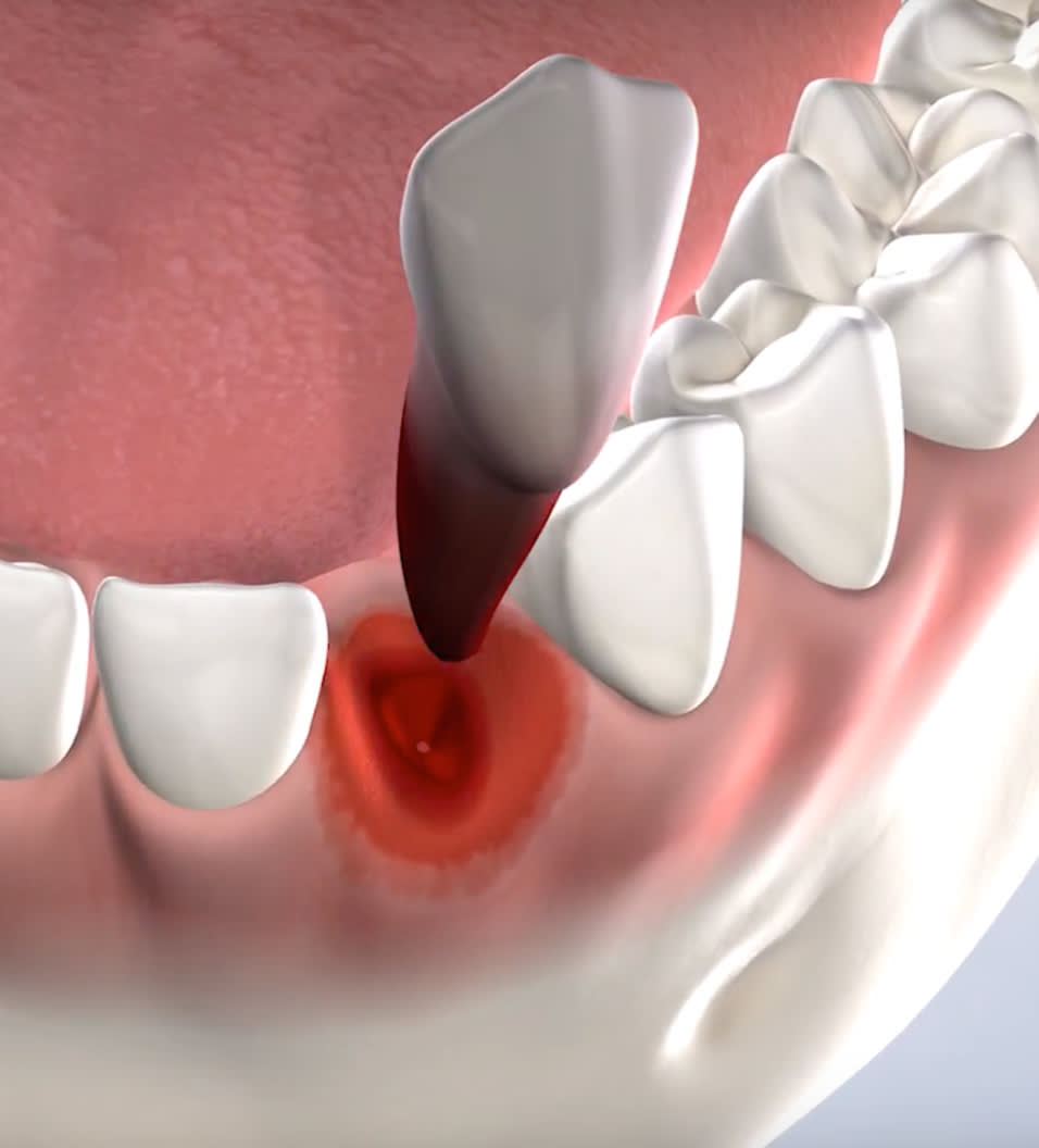 See how tooth extraction works.