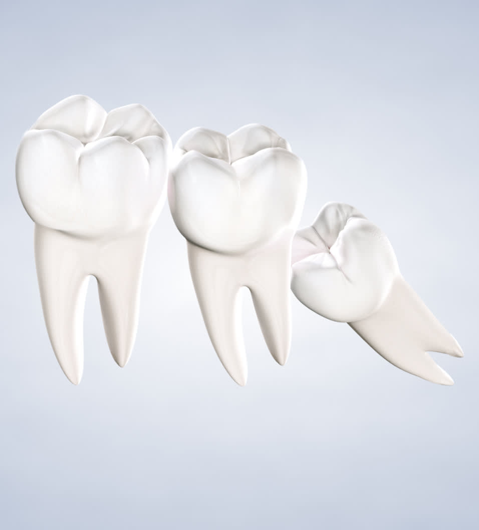 Understand the importance of wisdom teeth removal.